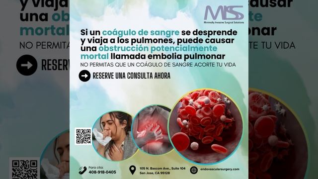 116-Spn Pulmonary embolism symptoms, Pulmonary embolism treatment, Blood clot in lungs, Causes of p смотреть онлайн