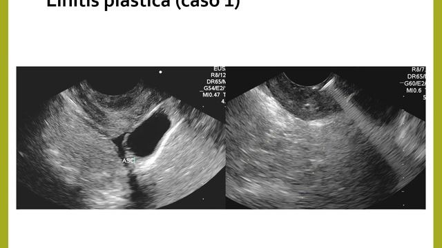 Miniatlas de Lesiones Subepiteliales y Tumores Gastrointestinales смотреть онлайн