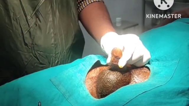 Uttarbasti In The Management Of Urethral Stricture#ayurveda #ayush #urology #uttarbastti #bph
