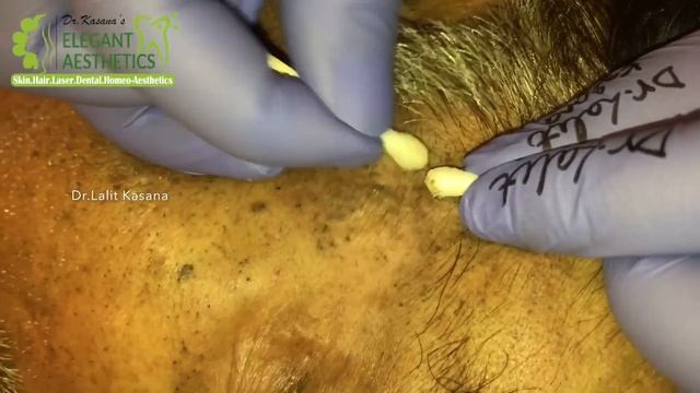 OLD BLACKHEAD REMOVAL WITH COTTON BUDS v/s EXTRACTOR- Dr.Lalit Kasana смотреть онлайн