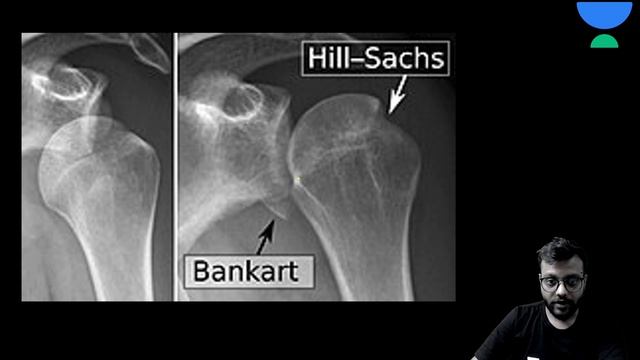 Rapid Revision-Shoulder Dislocation in 15 Min | Orthopaedics | Let's Crack NEET PG | DrAnshul Bansa смотреть онлайн