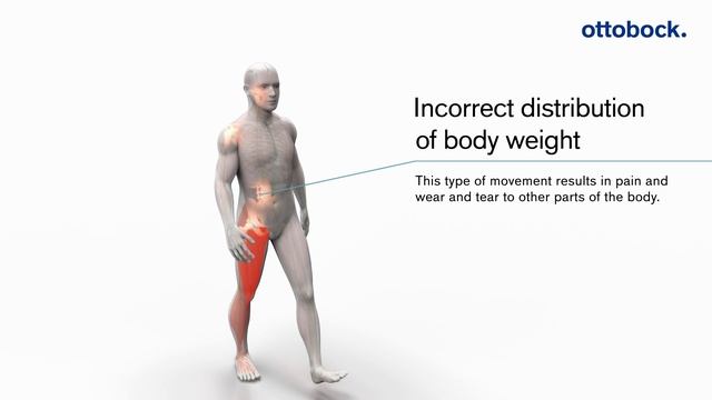 How the C-Brace® leg orthosis works | Ottobock смотреть онлайн