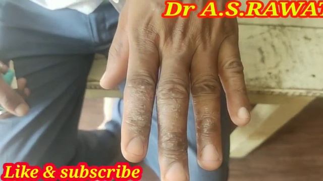 सीमेंट का रिएक्शन कैसा होता है | Dermatitis cement смотреть онлайн