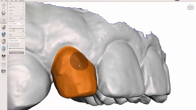 Meshmixer - Virtual Tooth Extraction