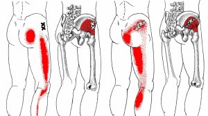 Триггеры в мышцах