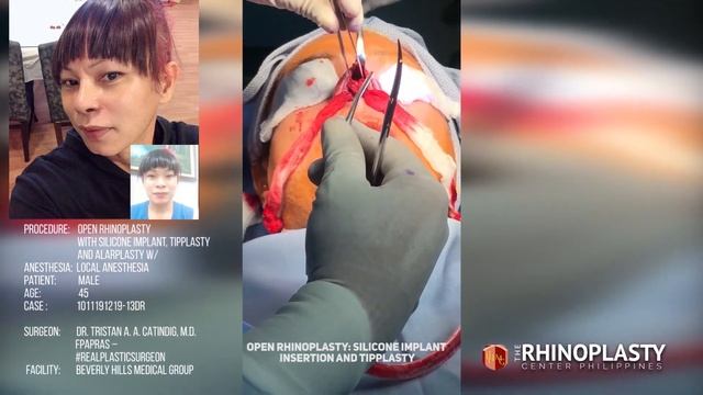 How It's Done: Open Rhino With Silicone, Tipplasty and Alarplasty (Male, 45 Yrs, Local Anesthesia) смотреть онлайн