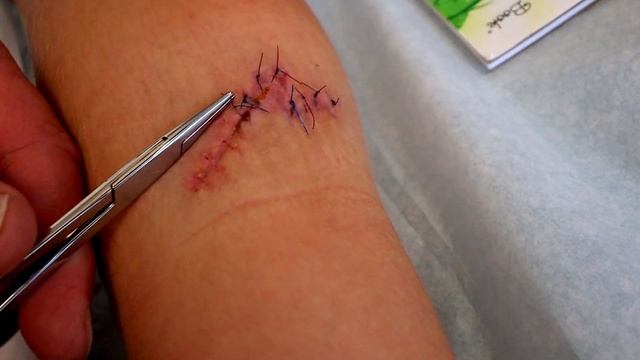 REMOVING 13 STITCHES (From a Huge Leg Wound) | Dr. Paul смотреть онлайн
