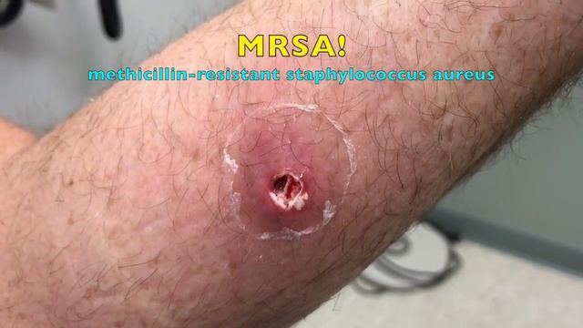 Hulk's Arm Update! Dr. Gilmore Treatment Video смотреть онлайн