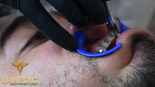 Procedimiento de cementado de brackets de autoligado смотреть онлайн