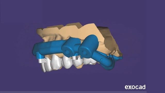Advanced Surgical Guides - DEMO смотреть онлайн