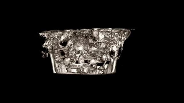WVOFS 3D Planning - Simultaneous Sinus Lift and Dental Implant 04 смотреть онлайн
