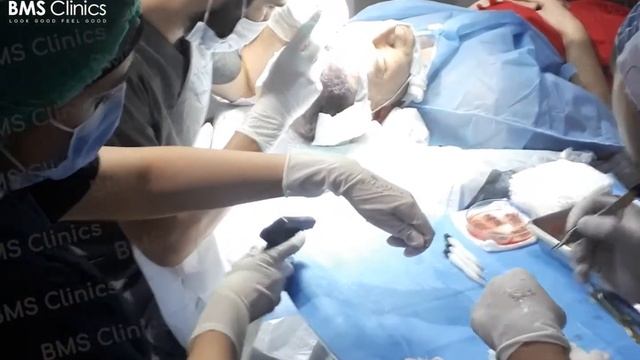OSL Sapphire hair transplant results at BMS Clinics in Istanbul Turkey смотреть онлайн
