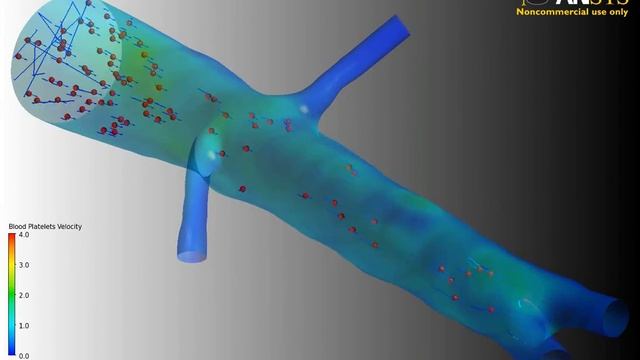 FSI Simulation Of A Subject-specific Segment With Impedance Boundary Condition