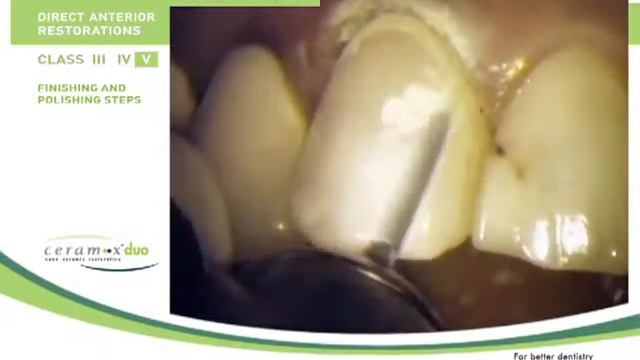 Реставрация от Dentsply часть 2 смотреть онлайн
