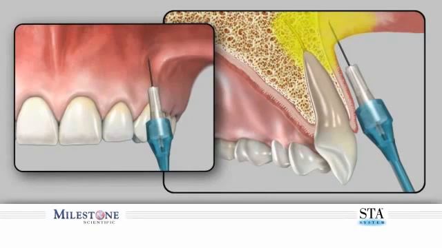 Инфильтрационная анестезия | Обзор смотреть онлайн