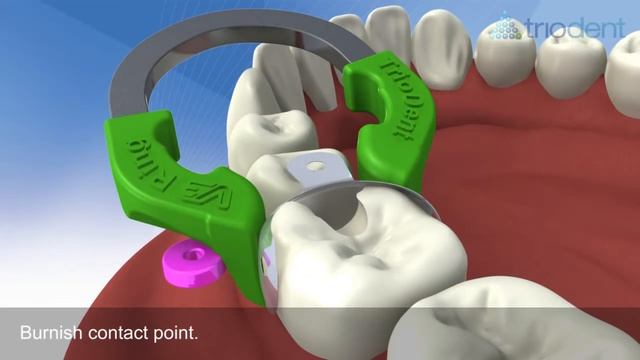 Triodent V3 ring Matrix смотреть онлайн