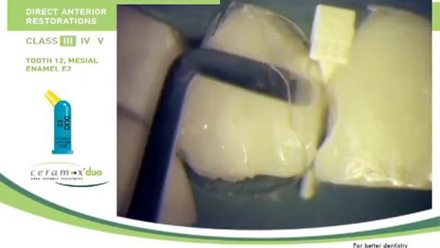 Реставрация от Dentsply часть 3 смотреть онлайн