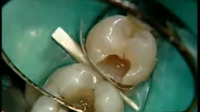 Обзор Quixfill часть 1 смотреть онлайн