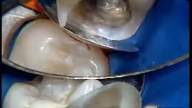 Обзор Ceram X mono class II часть 1 смотреть онлайн