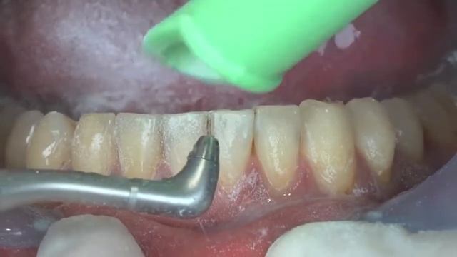 Обзор работы аппарата Prophy Mate neo M4 NSK | Ондент смотреть онлайн