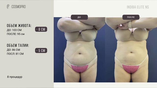 INDIBA Elite NS в повседневной практике врача-косметолога смотреть онлайн