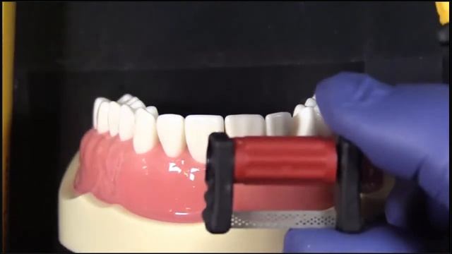 IPR Procedure With Fit Strips