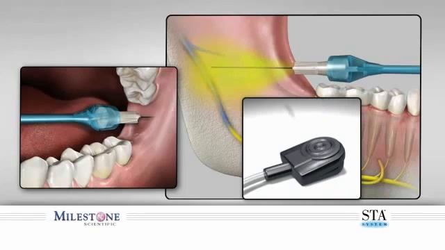 Мандибулярная анестезия | Обзор смотреть онлайн