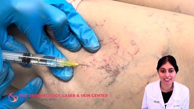 Sclerotherapy Varicose and Spider Vein Treatment | Dr. Shalini Gupta смотреть онлайн