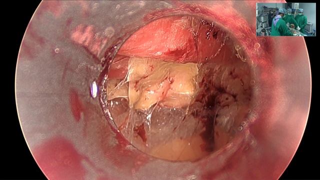 Part 1 LWSK 2024 Hernia Workshop (Day 1) Lap TEP Uncut смотреть онлайн