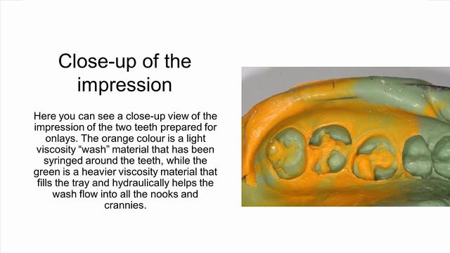 2 Porcelain Onlays Procedure