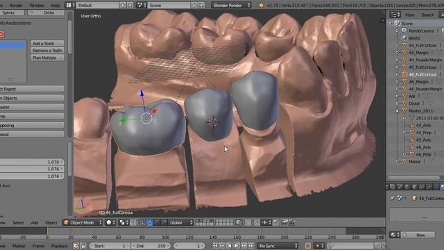 Blender Dental. Bridge Restoration