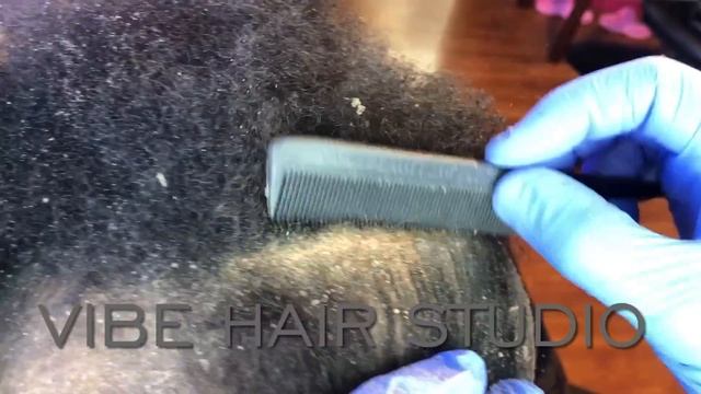 Dandruff Removal - Large Flakes - Good Scratch