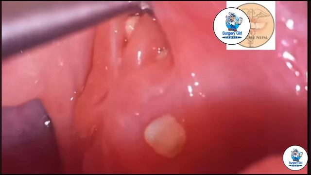 How to remove tonsil stones at home Tonsil stone removal смотреть онлайн