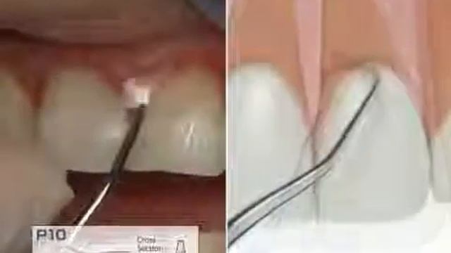 Обзор насадок Varios 970 | ОНДЕНТ смотреть онлайн