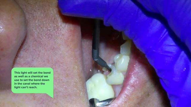 Full Root Canal & Crown Procedure w/ Post & Build-Up Placement Process. Dental Treatment On A Molar смотреть онлайн