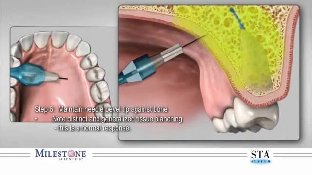 Нёбная анестезия | Обзор смотреть онлайн