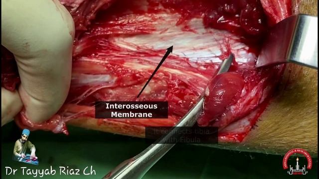 Below Knee Amputation | Step by Step | Video Based Learning - Dr Tayyab Riaz Ch смотреть онлайн