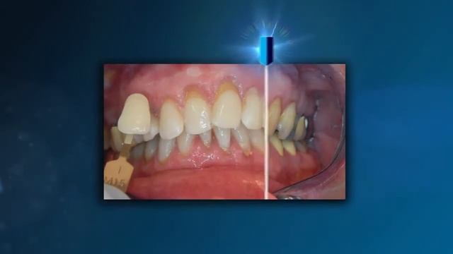 Philips Zoom WhiteSpeed Zoom 4 отбеливающая лампа нового поколения смотреть онлайн