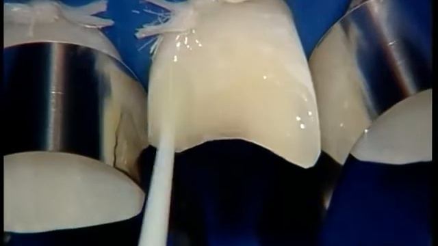 Обзор ceram x duo IV смотреть онлайн