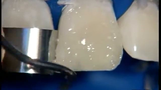 Обзор ceram x duo IV смотреть онлайн