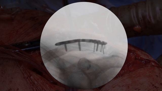 Distal Clavicle Fracture ORIF and CC Reconstruction смотреть онлайн