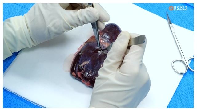 Chronic Kidney Disease patch process using AI software and 3D bioprinting convergence technology смотреть онлайн