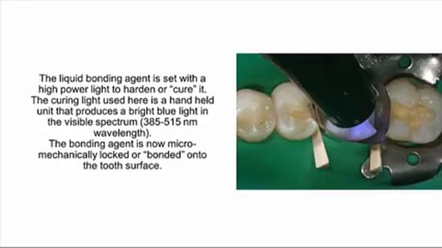 White Composite Filling Procedure смотреть онлайн
