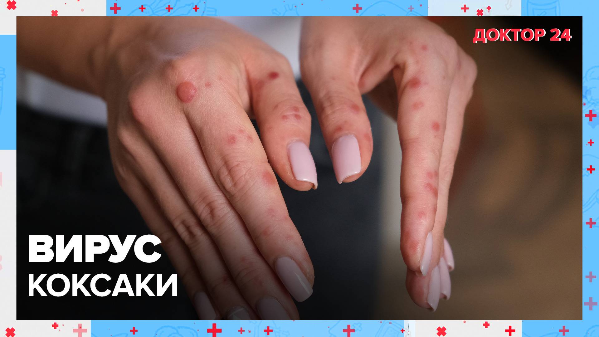 Вирус КОКСАКИ | Доктор 24 смотреть онлайн