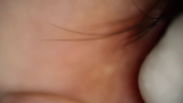 Popping Stye with Maskin Probe and Squeezing out Pus смотреть онлайн