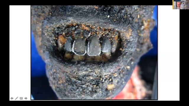 Stabilizing Severely Incinerated Dental Remains for Human Identification| Dr. John Berketa смотреть онлайн