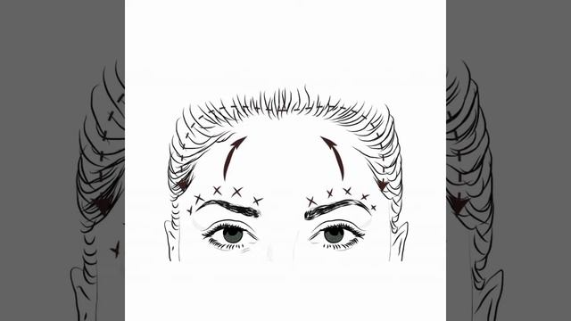 ღ Your Brows Are So Lifted! ~ Brow Lift Procedure 💉