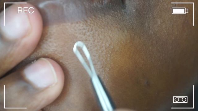 EXTRACTING MY PORES- EWWW смотреть онлайн