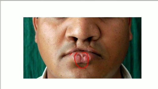 Van Der Woude Syndrome