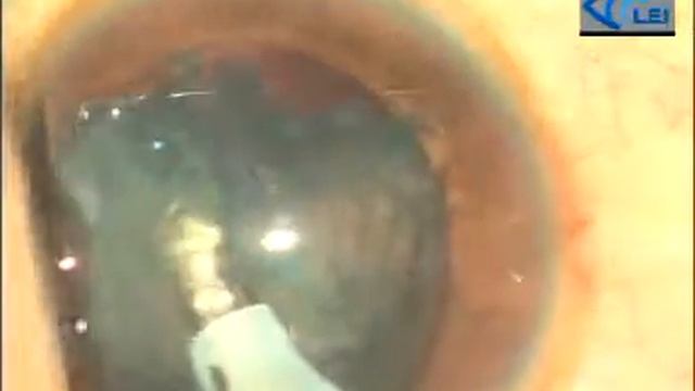 Phacoaspiration in soft cataract by Dr. Suhas Haldipurkar смотреть онлайн